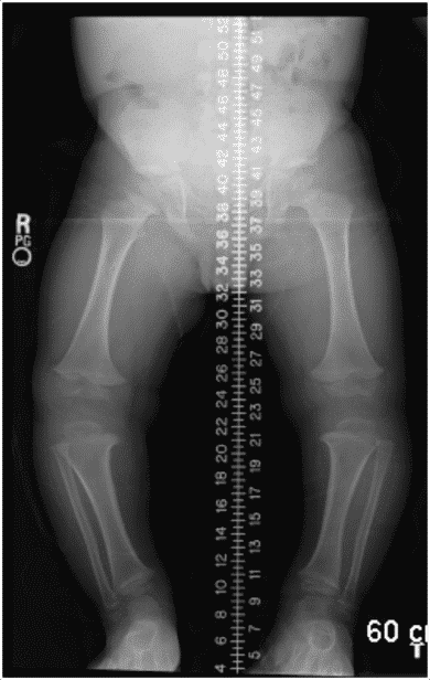 Key Techniques Hemiepiphysiodesis Guided Growth Llrs